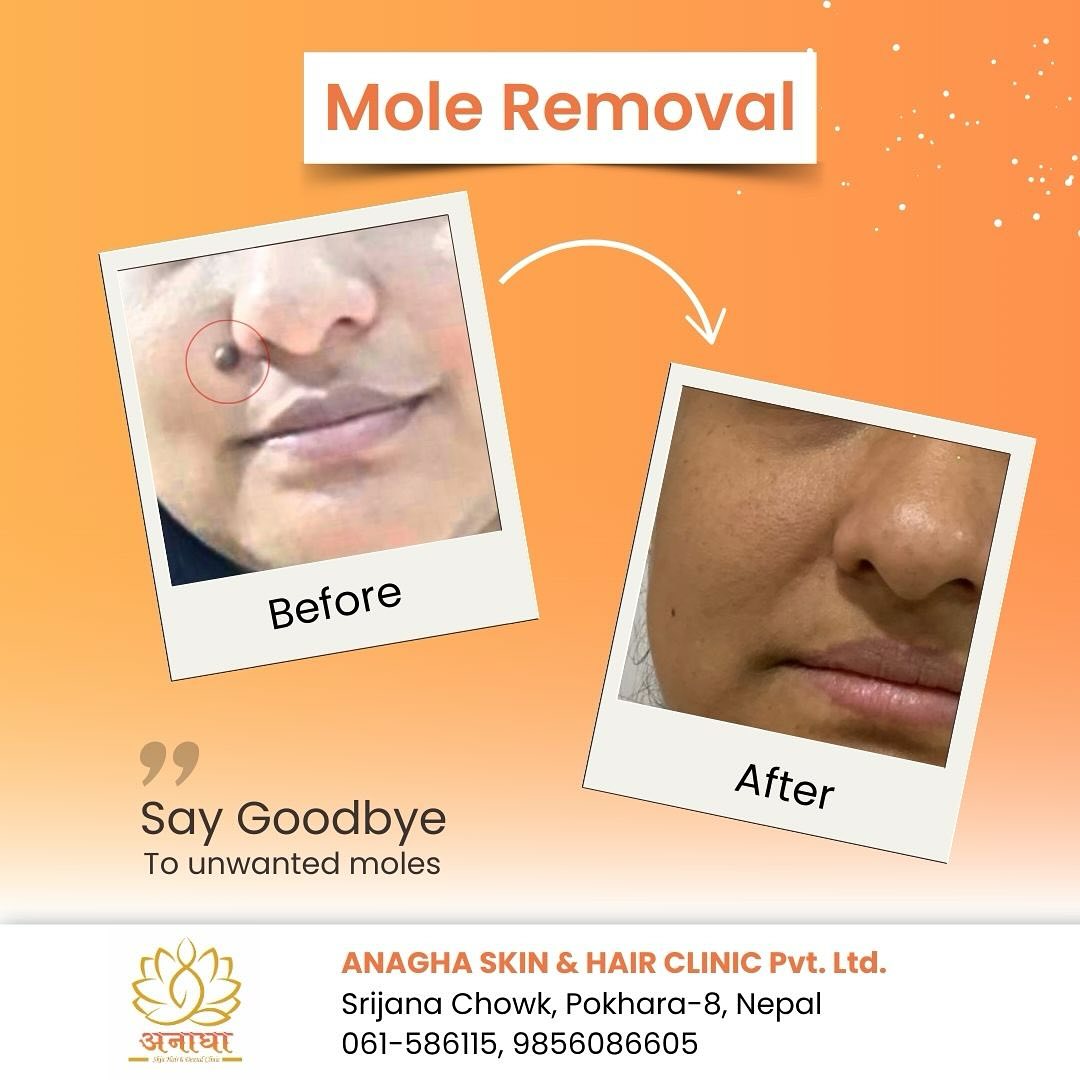 Mole Removal results